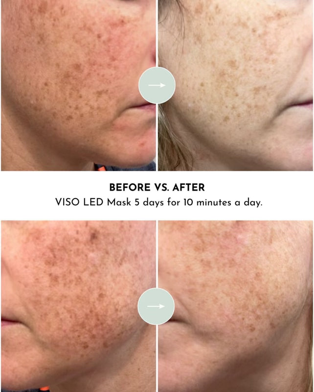 VISO - Red Light Therapy Mask
